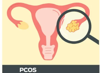 PCOS affects 30% women in Kashmir: Study